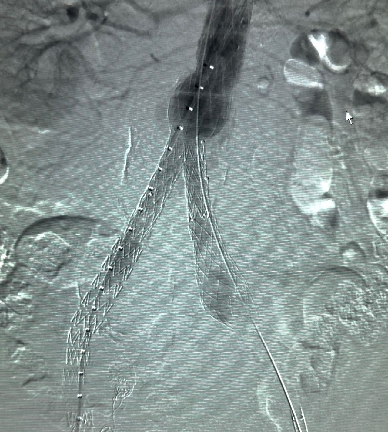 Imagem de tomografia mostrando endoprótese na aorta